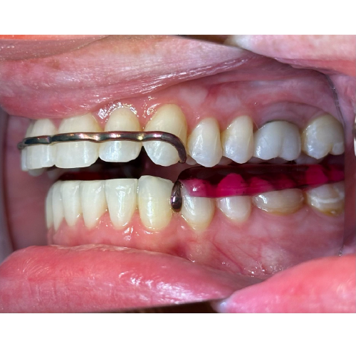 Atlas Maxillary and Atlas Mandibular TMD