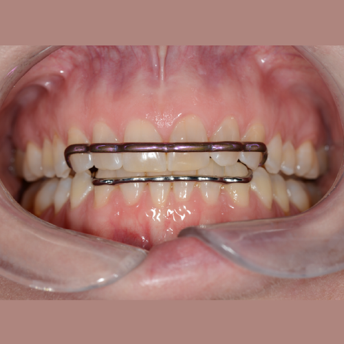 Atlas Maxillary & Mandibular Retainer