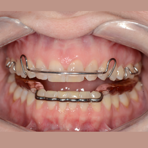 Hawley Maxillary and Atlas Mandibular TMD
