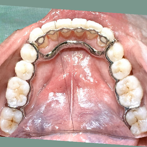 Combination Infinity and Atlas with lingual strap)