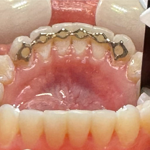 Infinity Fixed Lingual Retainer (Lower)