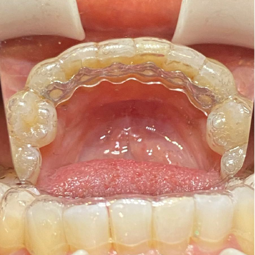 Infinity Fixed Lingual Retainer TMO with Hercules