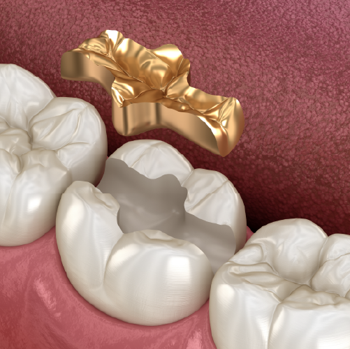Inlay gold